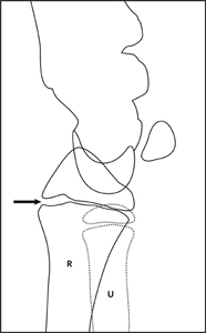 Fracture_Distal radius physeal_Figure 2_1396963-salter-harris I_lat_drawing.jpg